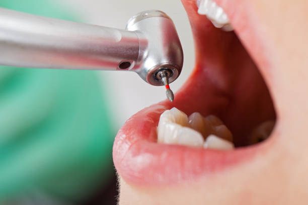 Best Emergency Wisdom Tooth Extraction in South Hill, WA